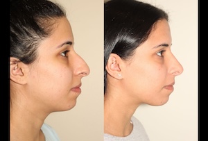 Before & After images of Facial liposuction of a young woman