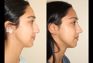 Before & After images of Facial liposuction of a young woman