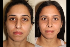 Before & After images of Facial liposuction of a young woman