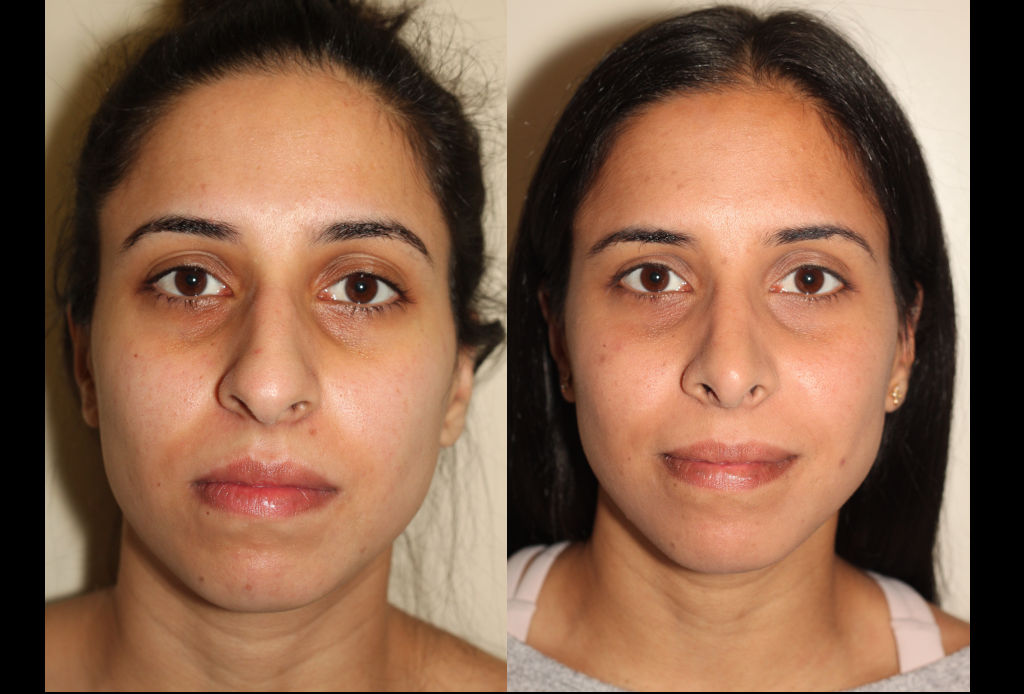 Before & After images of Facial liposuction of a young woman