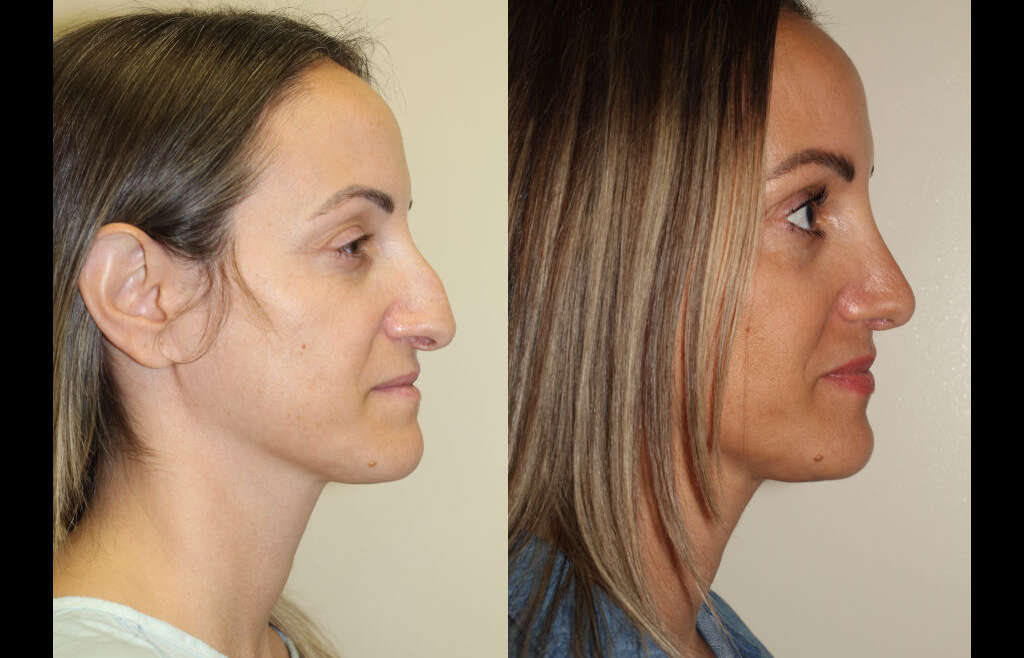 Open vs. Closed Rhinoplasty in Vancouver