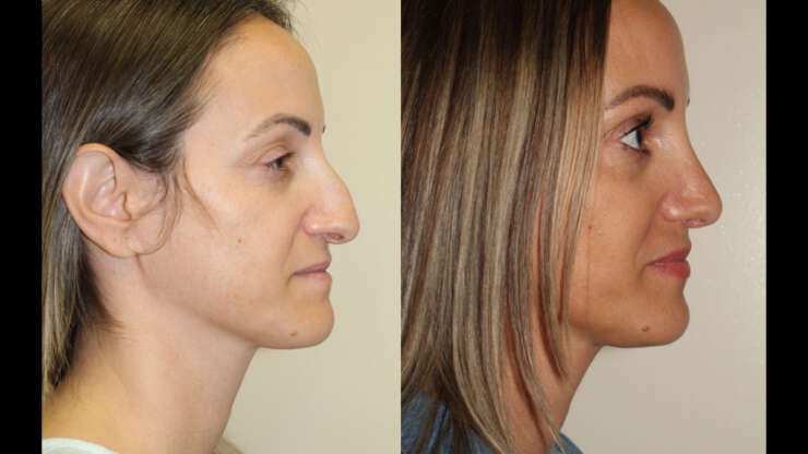 Open vs. Closed Rhinoplasty in Vancouver