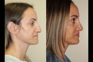 Before & After images of Facial liposuction of a young woman