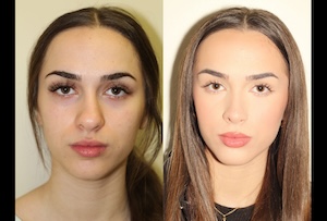 Before & After images of Facial liposuction of a young woman