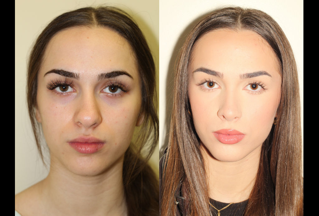 Before & After images of rhinoplasty of a young woman