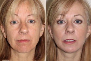 Dr. Denton chin implant before and after photo of a female patient