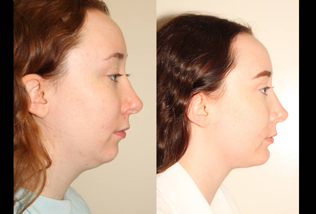 a before and after photo of a female who has undergone facial liposuction