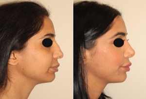 Dr. Denton Rhinoplasty before and after photo of a female patient