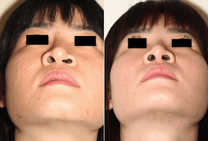 Dr. Denton Asian rhinoplasty before and after photo of a female patient