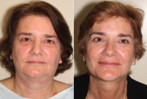 Dr. Denton blepharoplasty before and after photo of a female patient