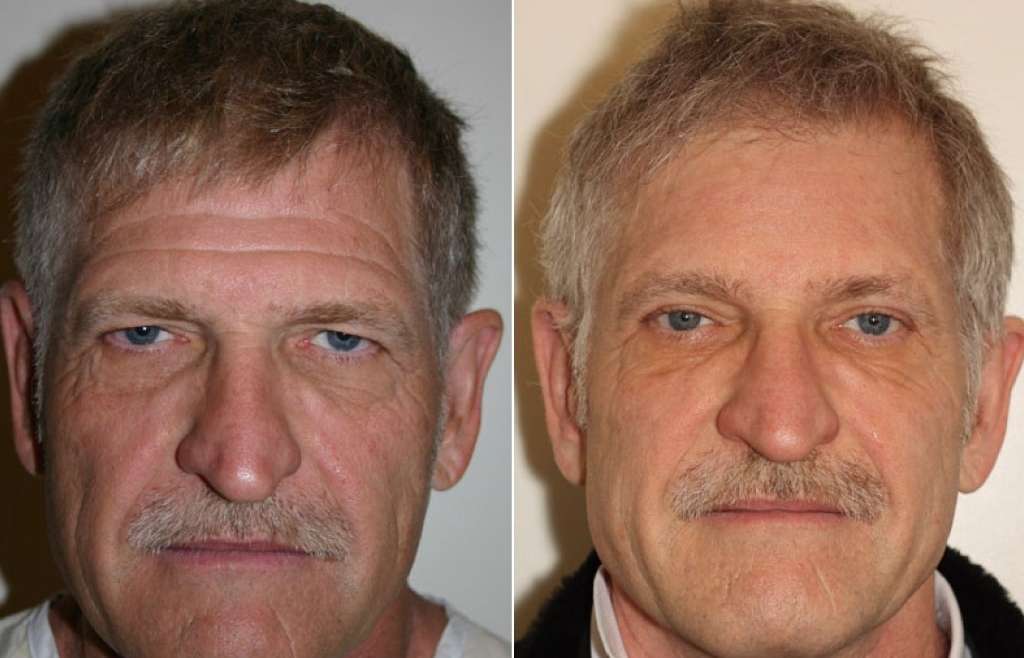 Get Rid of Deep Forehead Wrinkles with a Browlift