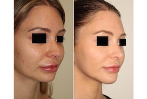 Dr. Denton rhinoplasty and chin implant before and after photo of a female patient