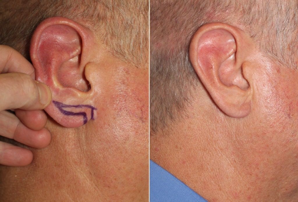 Dr. Denton Otoplasty before and after - ear lobe reduction