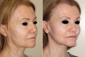 Dr. Denton facelift before and after photo of a female patient