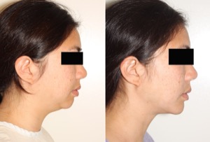 Dr. Denton liposuction before and after photo of a female patient