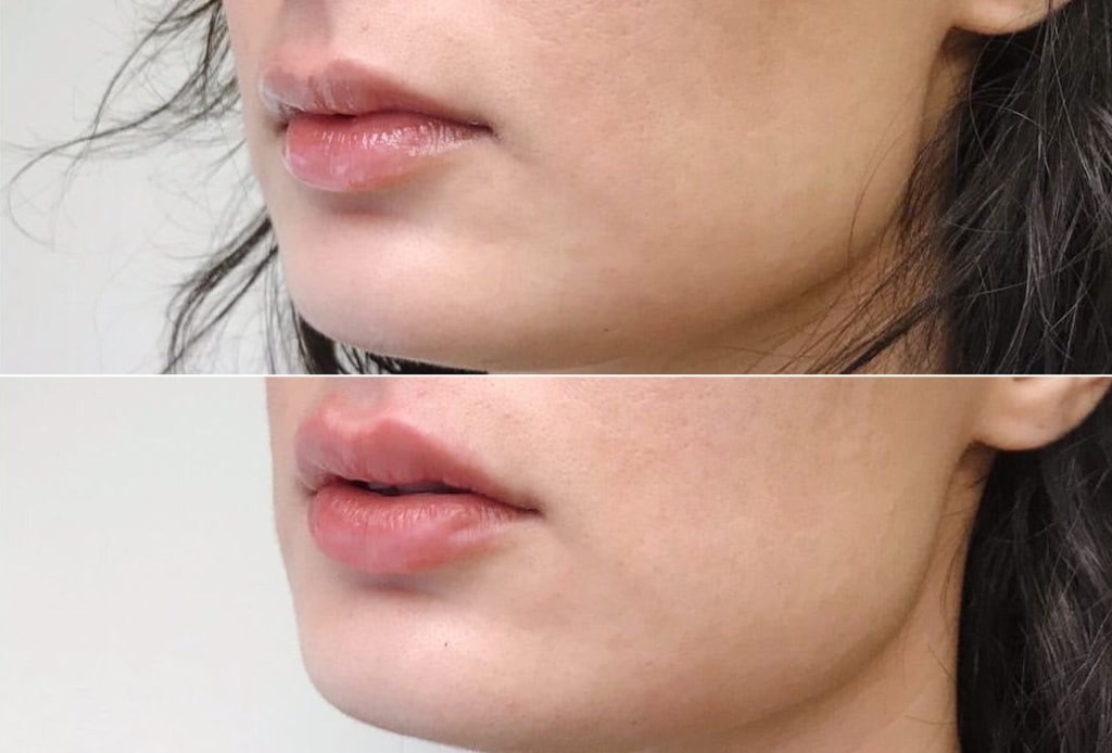 Dr. Denton lip filler before and after photo of a female patient