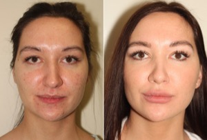 Dr. Denton Rhinoplasty before and after photo of a female patient