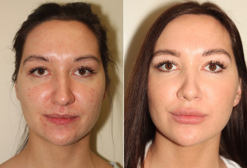 Dr. Denton Rhinoplasty before and after photo of a female patient