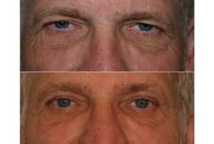 Dr. Denton blepharoplasty before and after photo of a male patient