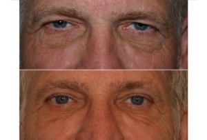 Brow Lift Surgical Procedure – Endoscopic Approach