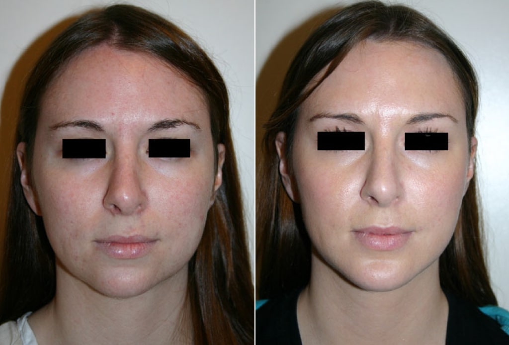 Dr. Denton chin implant before and after photo of a female patient