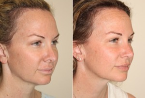 Dr. Denton Rhinoplasty before and after photo of a female patient