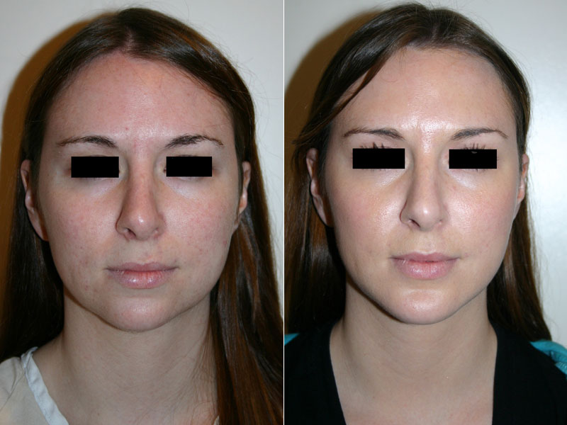 Before and after images of a young female who has undergone chin implant surgery.