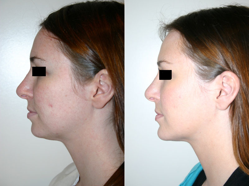 Before and after images of a young female who has undergone chin implant surgery.