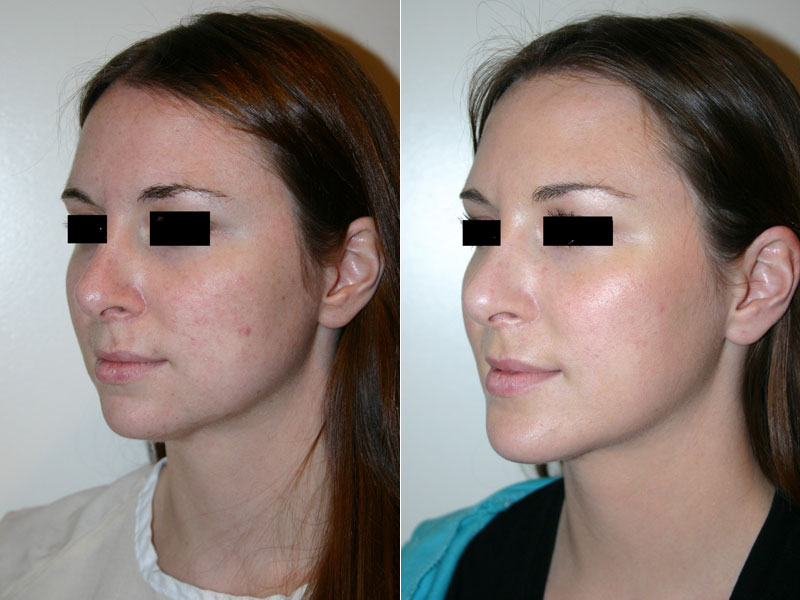 Before and after images of a young female who has undergone chin implant surgery.