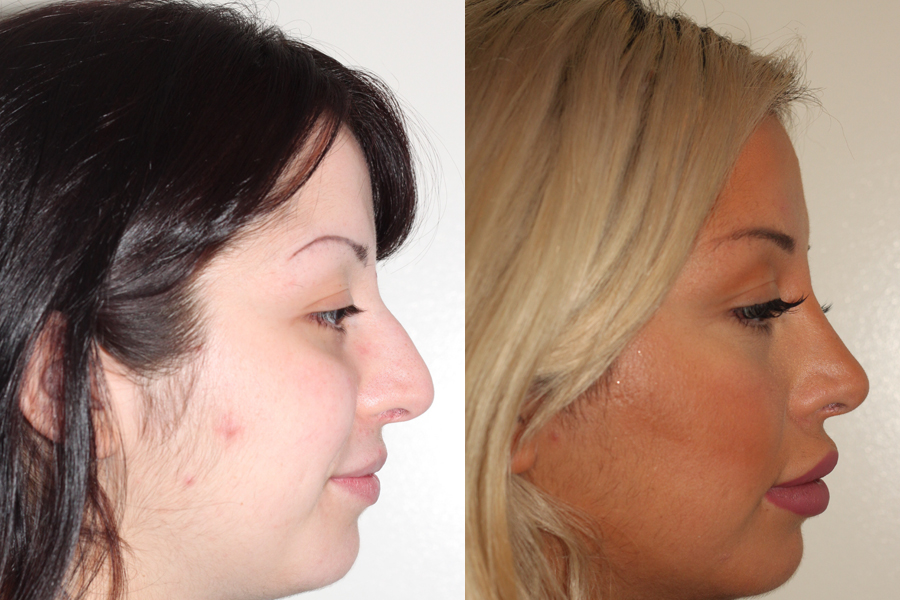 Before & After | 5 year follow up | Closed Rhinoplasty | Lateral View 