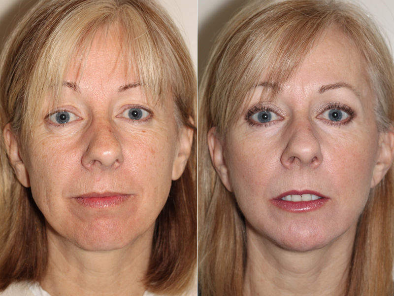 Before and after images of a 50 year old female who has undergone Facelift surgery and chin implant surgery in Vancouver to improve loss of skin tone along jaw line.