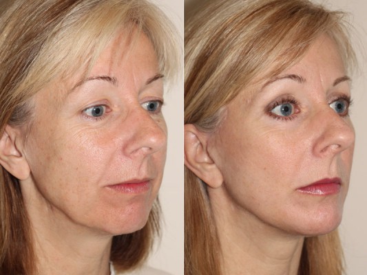 Facelift Surgery in Vancouver – Plastic Surgery for Facelifts