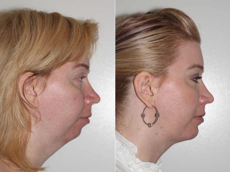 Before and after images of a female who underwent chin implant surgery and facial liposuction.