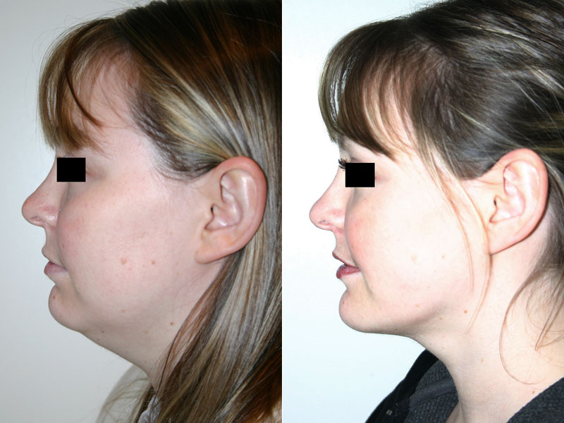 Before and after images of 33 year old female who underwent chin implant and facial liposuction surgery, showing the positional change of the chin and contour of the neck and jaw line.