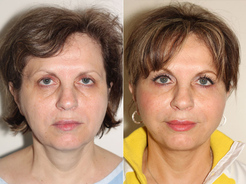 Before and after images of a 57 year old female who has undergone an SMAS facelift with Dr. Denton to remove excess fat.