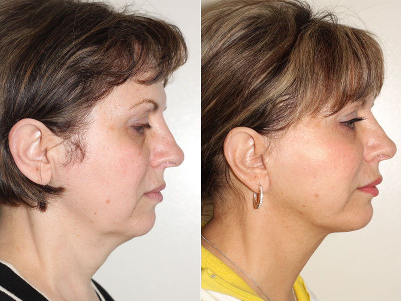 Before and after images of a 57 year old female who has undergone an SMAS facelift with Dr. Denton to remove excess fat.