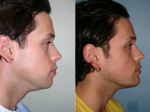 Before and after images of a young male who has undergone chin implant surgery and facial liposuction.