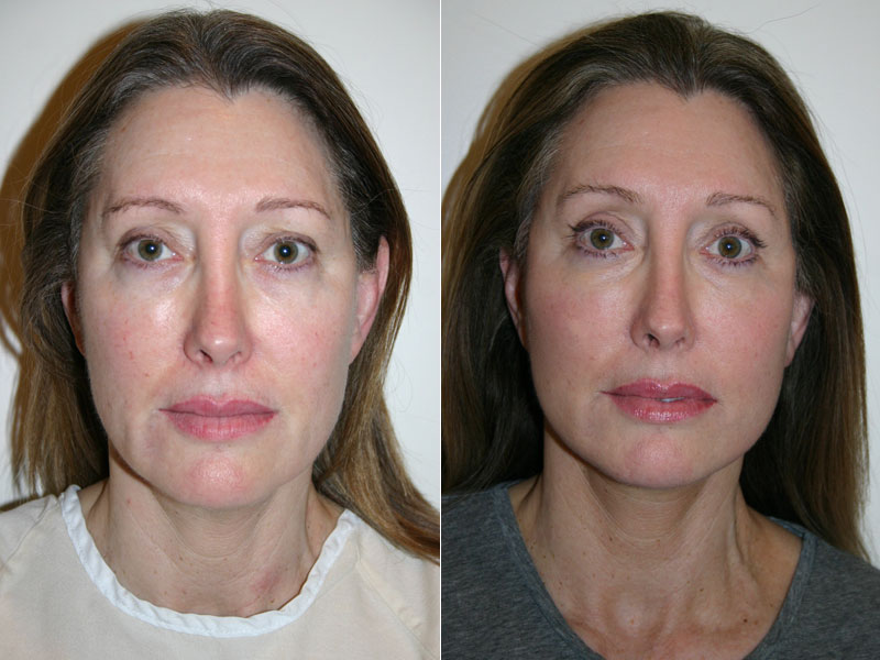 Before and after image of female who has undergone browlift - an upper eyelid blepharoplasty and an endoscopic forehead lift.