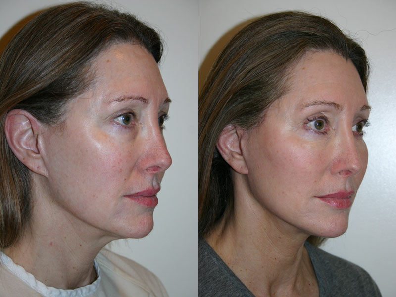 Before and after photos of facelift surgery showing improvements in jaw and chin of a female patient.