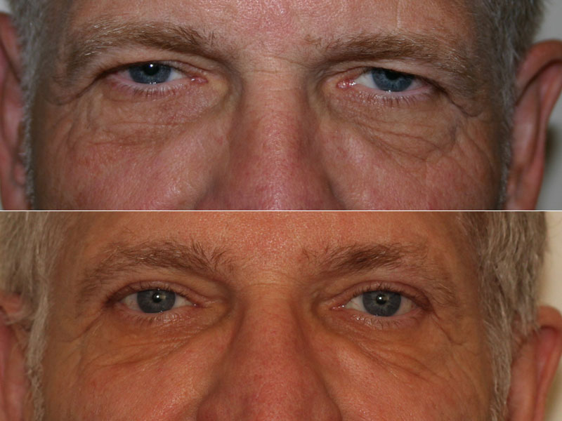 Before and after close-up image of a 59 year old male who has undergone upper eyelid blepharoplasty surgery and endoscopic browlift surgery.