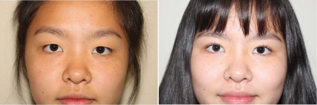 Before and After Image of Asian plastic surgery on a young female who has undergone Upper Eyelid cosmetic facial plastic surgery.