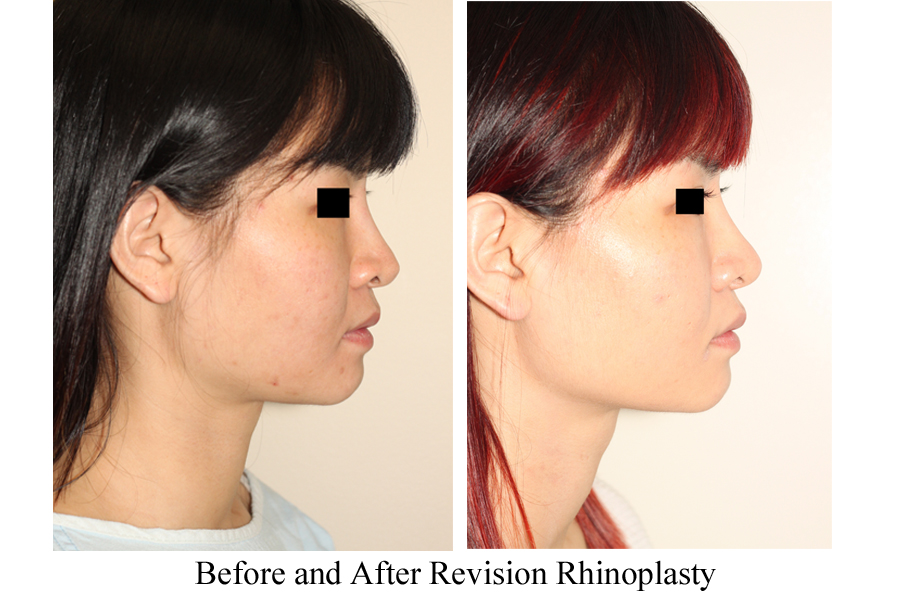 Before & After Revision Rhinoplasty Nasal Augmentation - Side View 