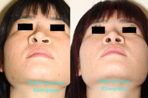 Before and after images of Asian plastic surgery on a female who has undergone a Revision Rhinoplasty.
