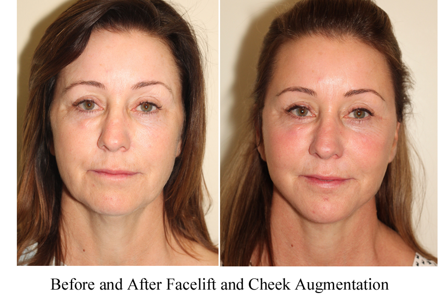 Before and after images of a female who has undergone a Facelift and Cheek Augmentation.