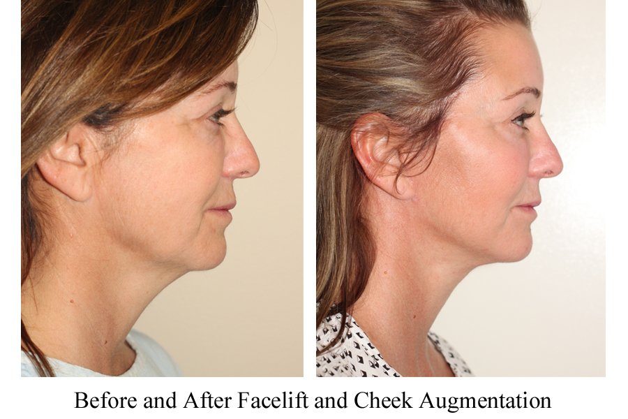 Before and after images of a female who has undergone a Facelift and Cheek Implant Surgery.