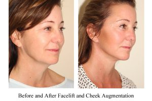 Before and after images of a female who has undergone a Facelift and Cheek Implant Surgery.