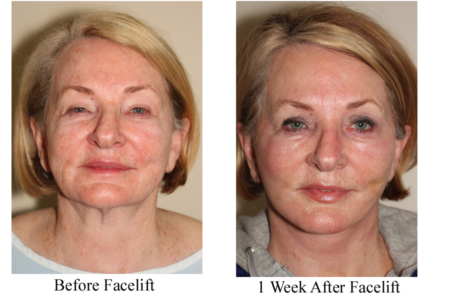 Facelift Before and After