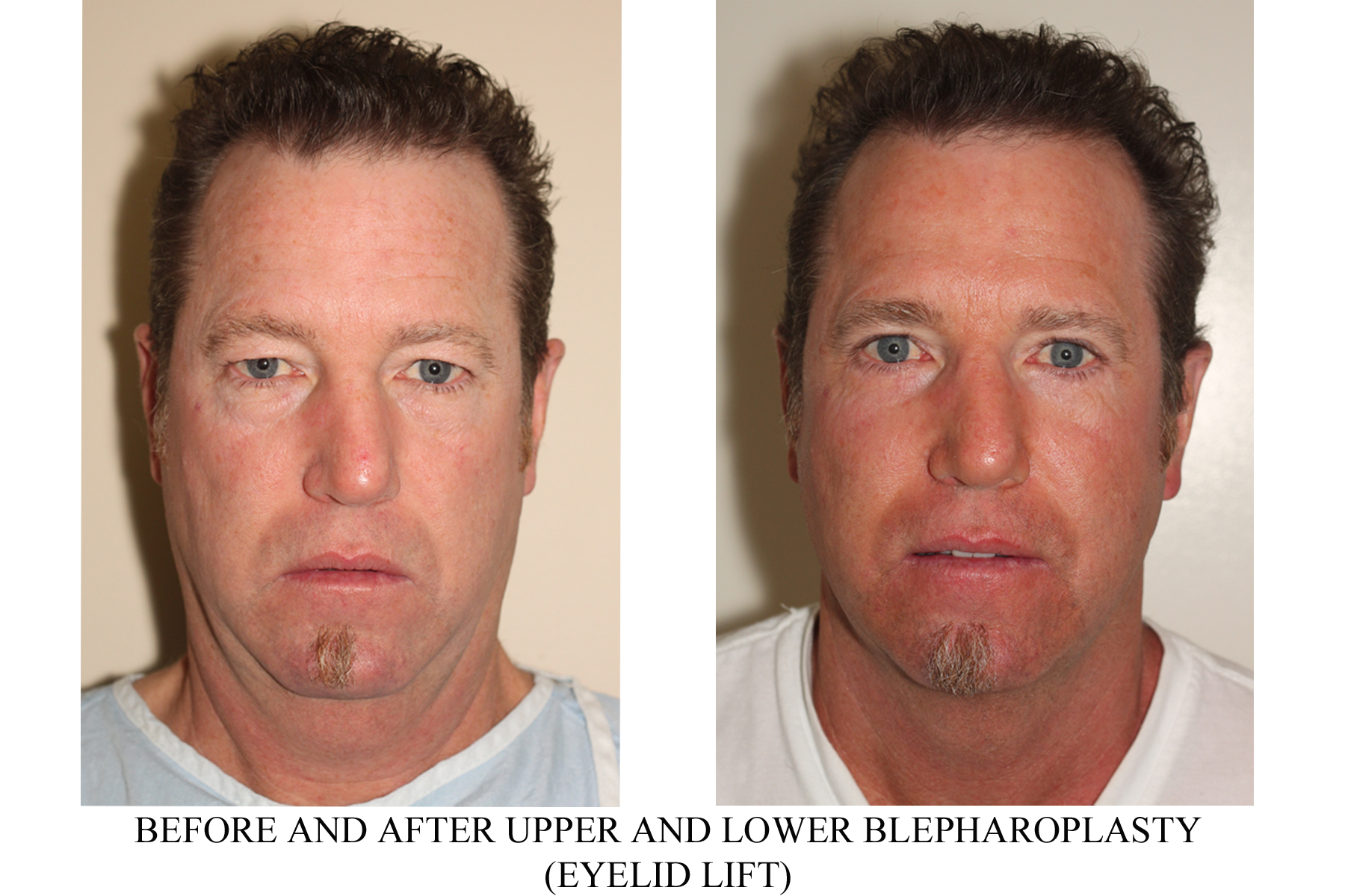 Upper and shop lower eyelid surgery