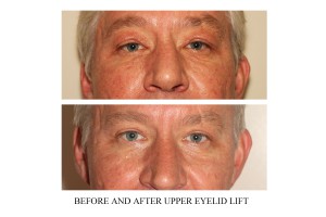 Before and after image of a male who has undergone upper blepharoplasty surgery in Vancouver to result in more youthful appearance.