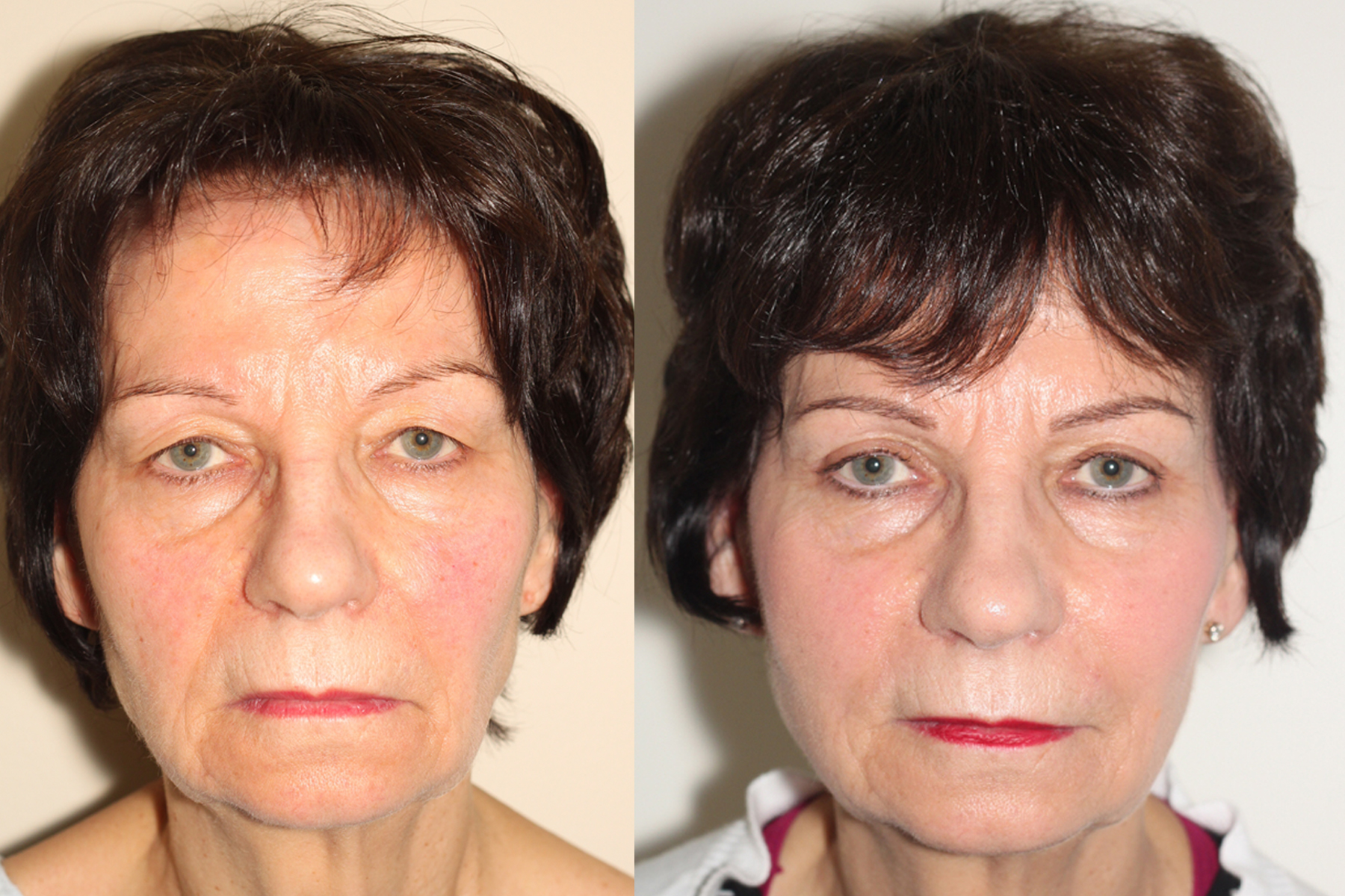 Before and After image of a female who has undergone Eyelid lift surgery.